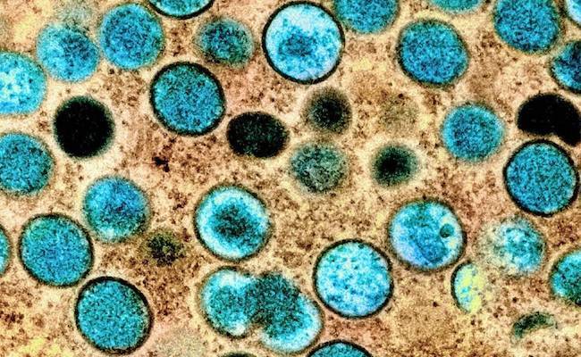 Un nuevo estudio afirma que la viruela del mono se detecta en muestras de saliva, rectales, nasofaríngeas, de semen, de orina y fecales. / NIAID
