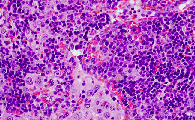 Imagen de microscopía de un bazo que presenta un linfoma desarrollado por ratones que expresan una mutación oncogénica en el gen VAV1. / Xose? R. Bustelo